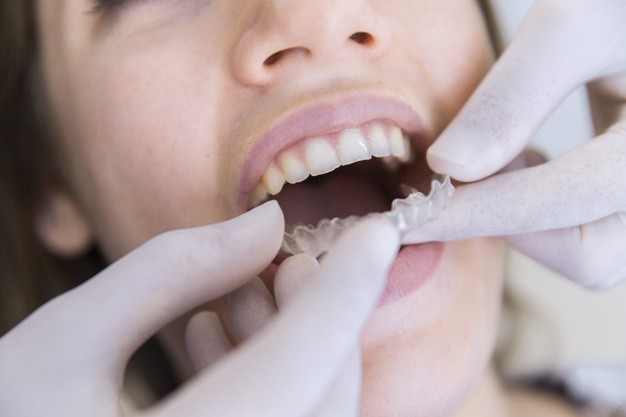 Invisalign with teeth Implants